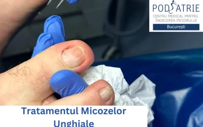 Ce sunt și cum se tratează micozele unghiale?